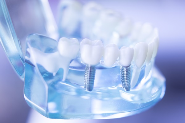 When It Makes Sense To Get Dental Implants [Cosmetic Dentist]