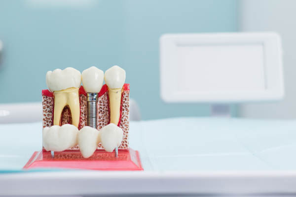 Dental Implants Will Blend In With Your  Teeth