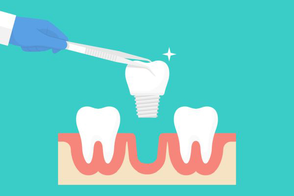 A Cosmetic Dentist Near You Shares Why Dental Implants Maybe The Right Choice For You