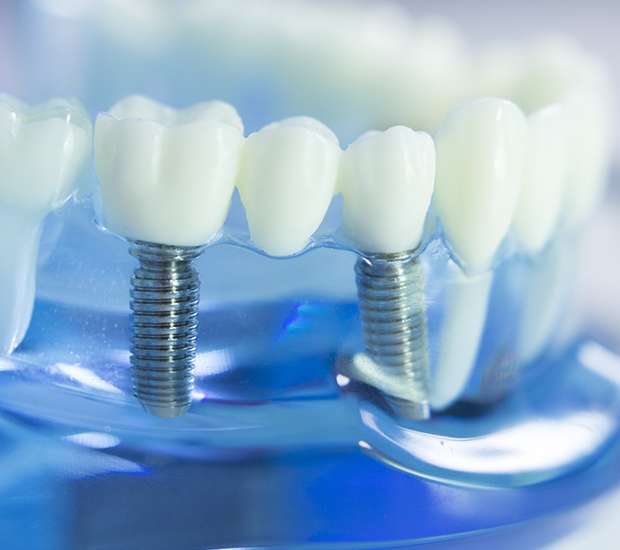 Jackson Heights Dental Implants