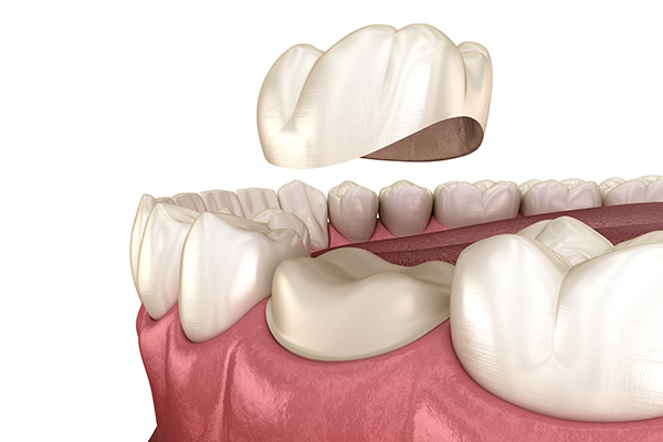 A General Dentist Answers Questions About Dental Crown Material Options