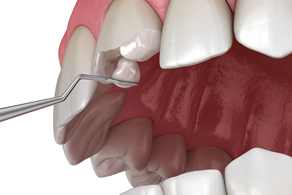 How A General Dentist May Treat A Broken Tooth