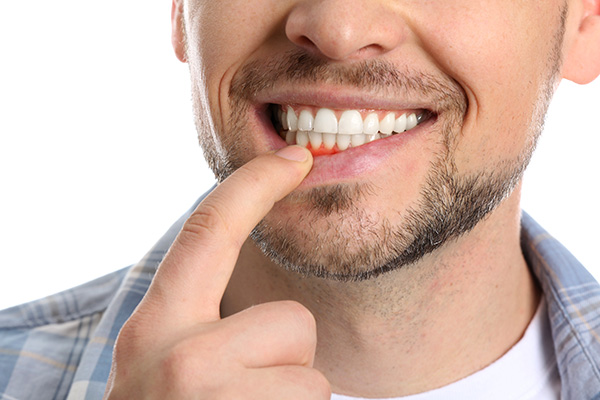 How A General Dentist Treats Gingivitis