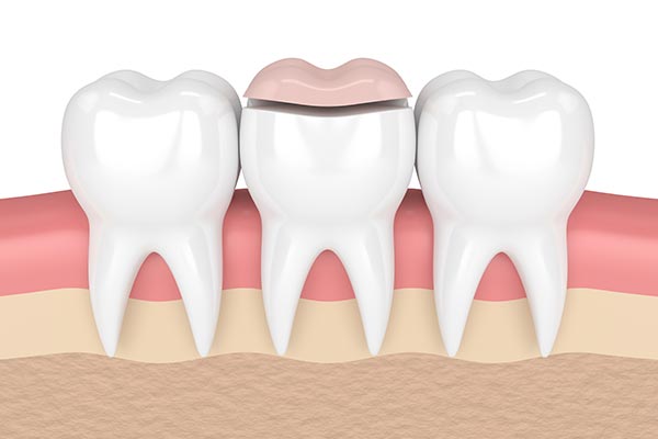 How a Cosmetic Dentist Can Place Inlays and Onlays from 82nd St. Dental in Jackson Heights, NY