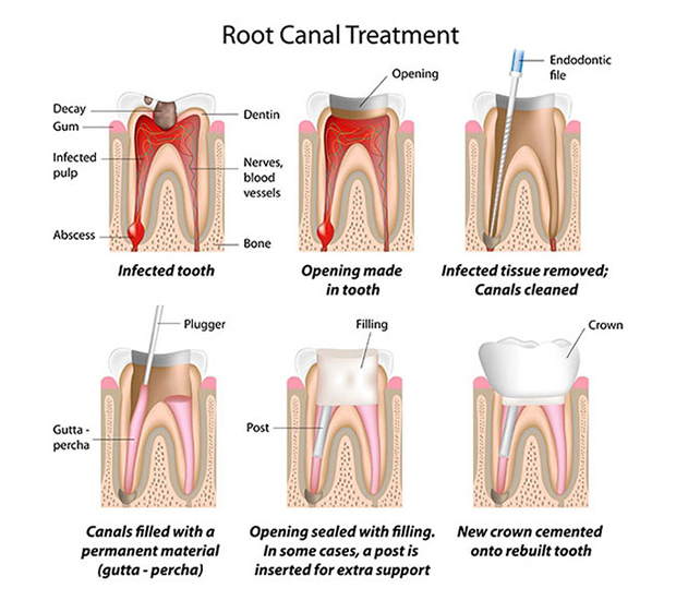 Jackson Heights Root Canal Treatment