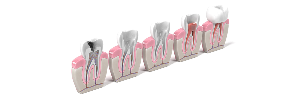 Jackson Heights Root Canal Treatment