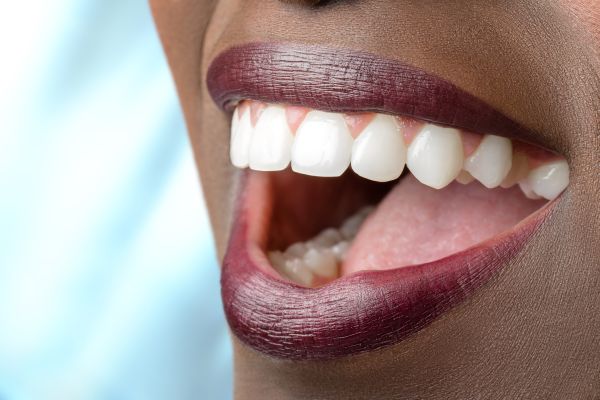 Why Choose Zoom Teeth Whitening Over Other Bleaching Methods?